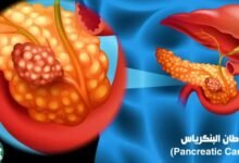 Revolution Medicines تحصل على موافقة أميركية لعلاج سرطان البنكرياس