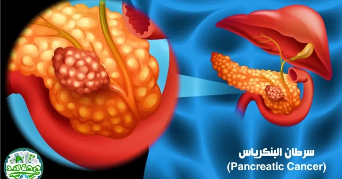 صورة مميزة: Revolution Medicines تحصل على موافقة أميركية لعلاج سرطان البنكرياس