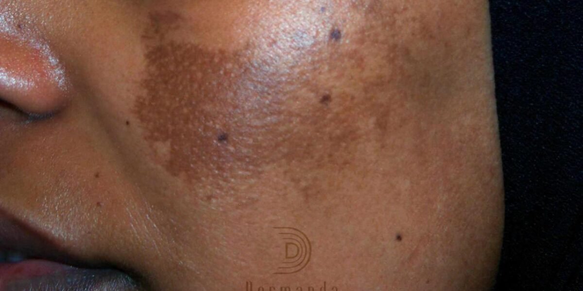 Dermanda Clinic إسم رائد في علاج الكلف بمختلف أنواعه - صورة مميزة صورة مميزة: Dermanda Clinic إسم رائد في علاج الكلف بمختلف أنواعه